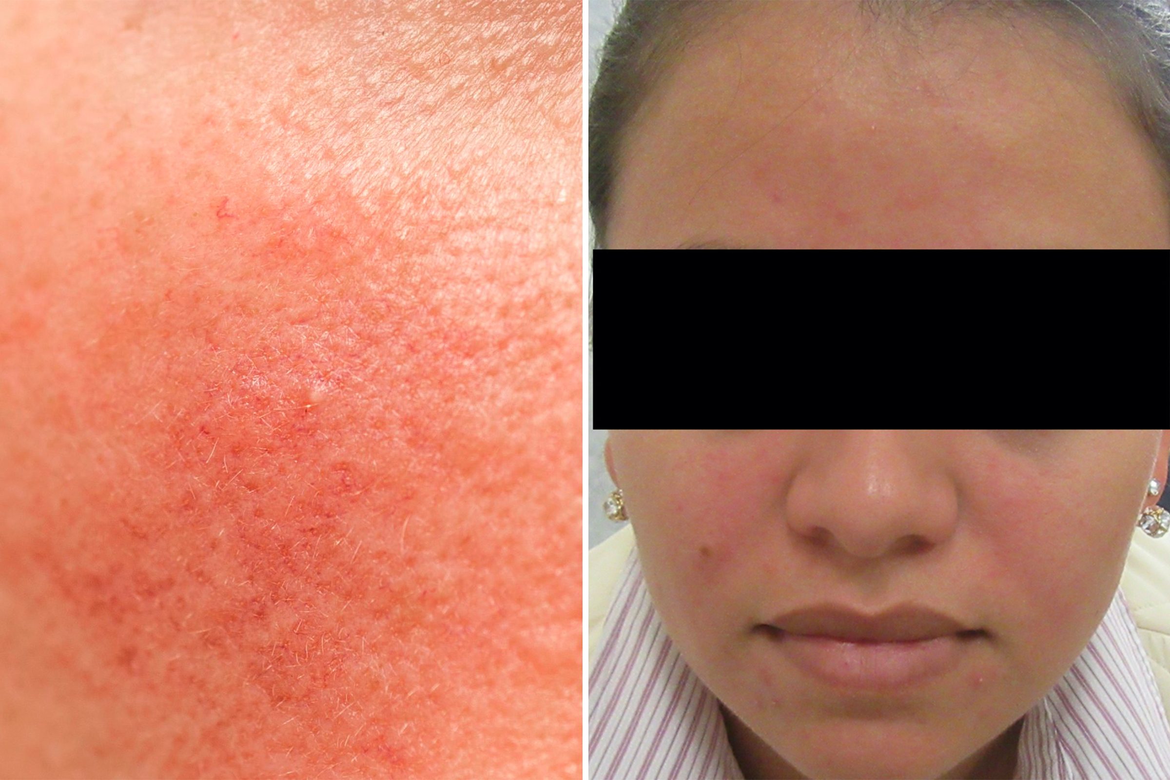 rosacea 피부 상태에 얼굴