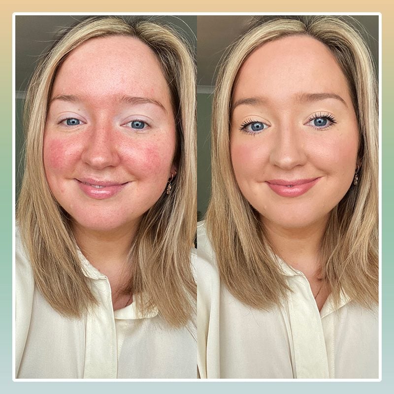 Here's How a Beauty Pro Keeps Her Rosacea Under Control