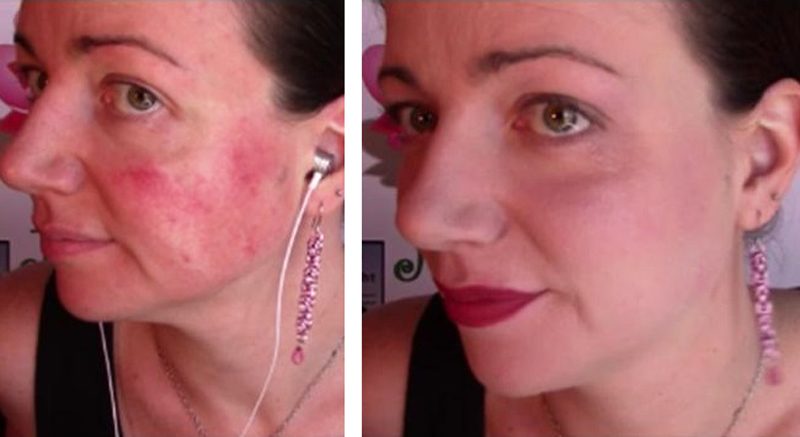 Julie B. Campbell rosacea viaggio