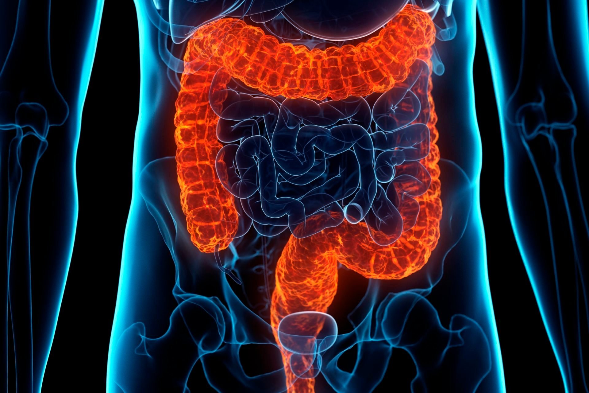 What You Need to Know About Ulcerative Colitis
