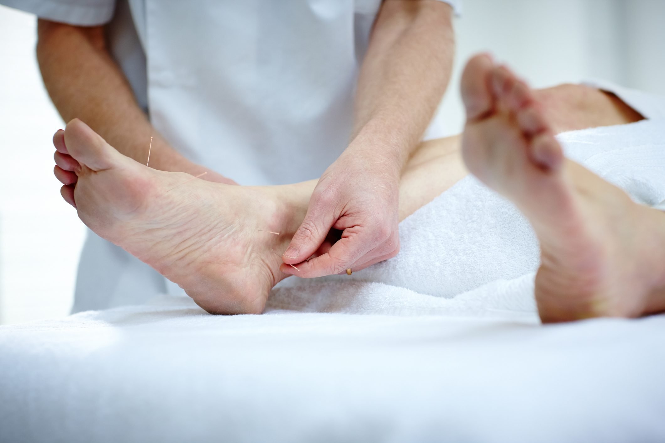 What to Know About Acupuncture for Plantar Fasciitis