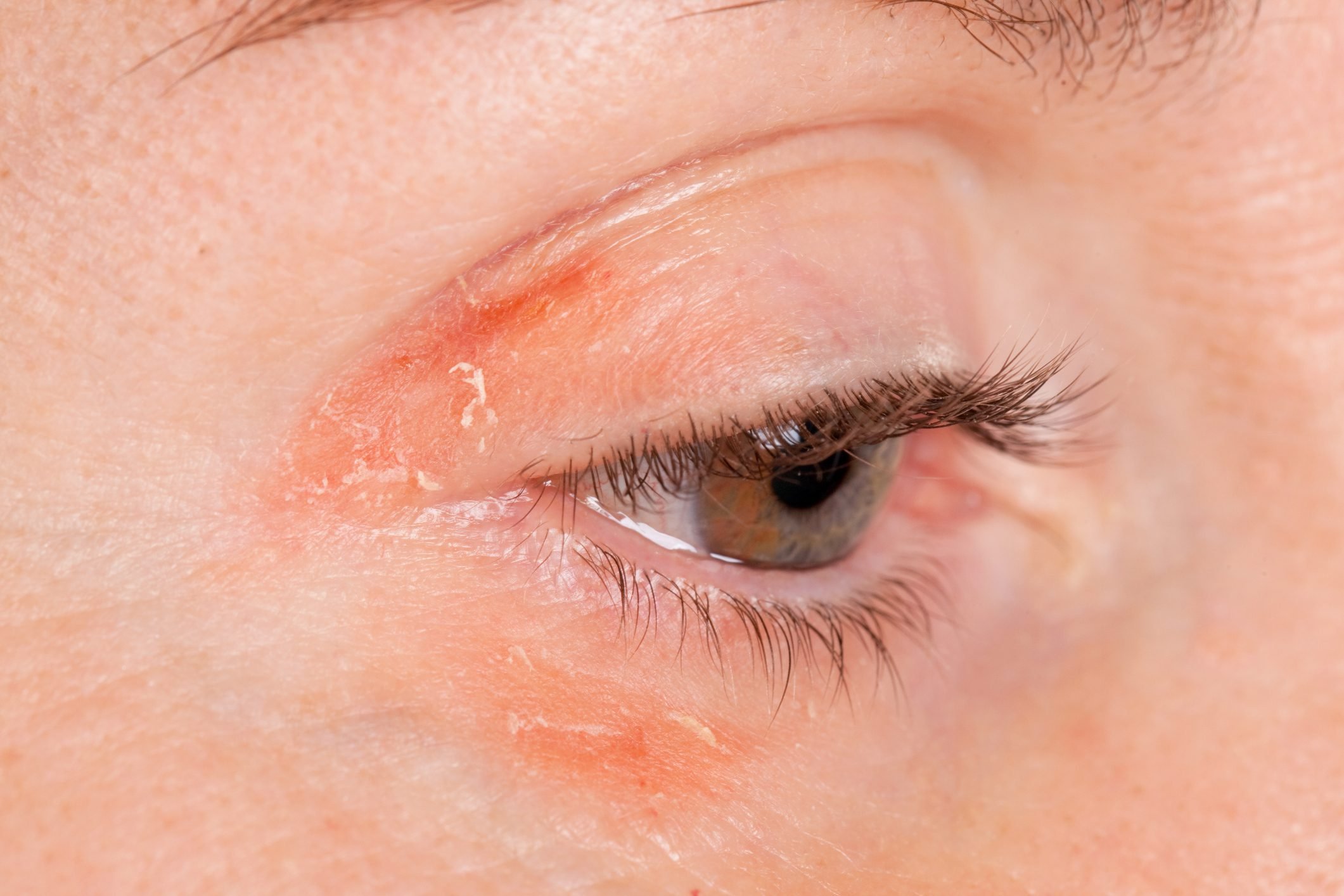 8 Tips for Dealing With Psoriasis on Your Eyelids