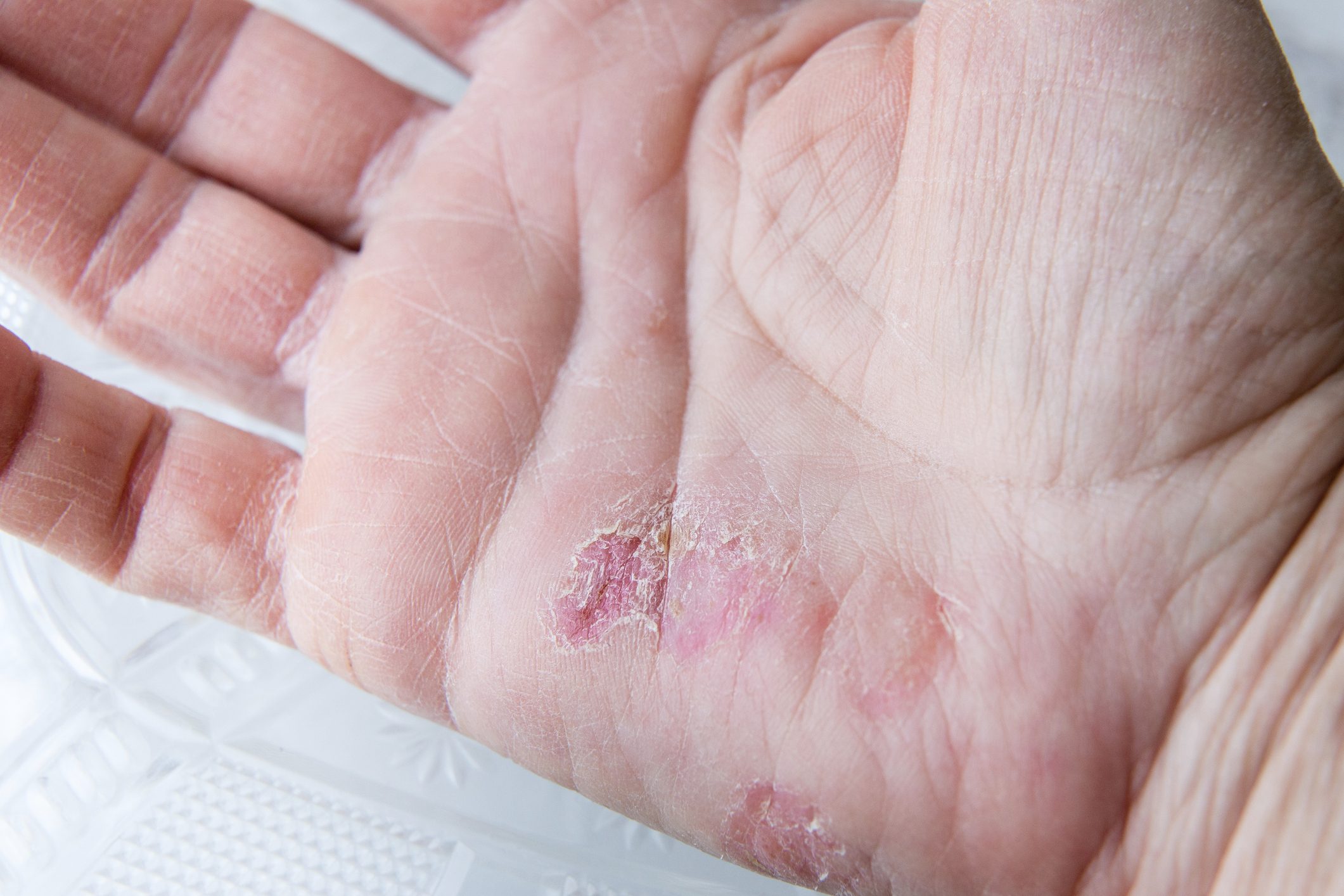 18 Things You Should Know About Palmoplantar Psoriasis