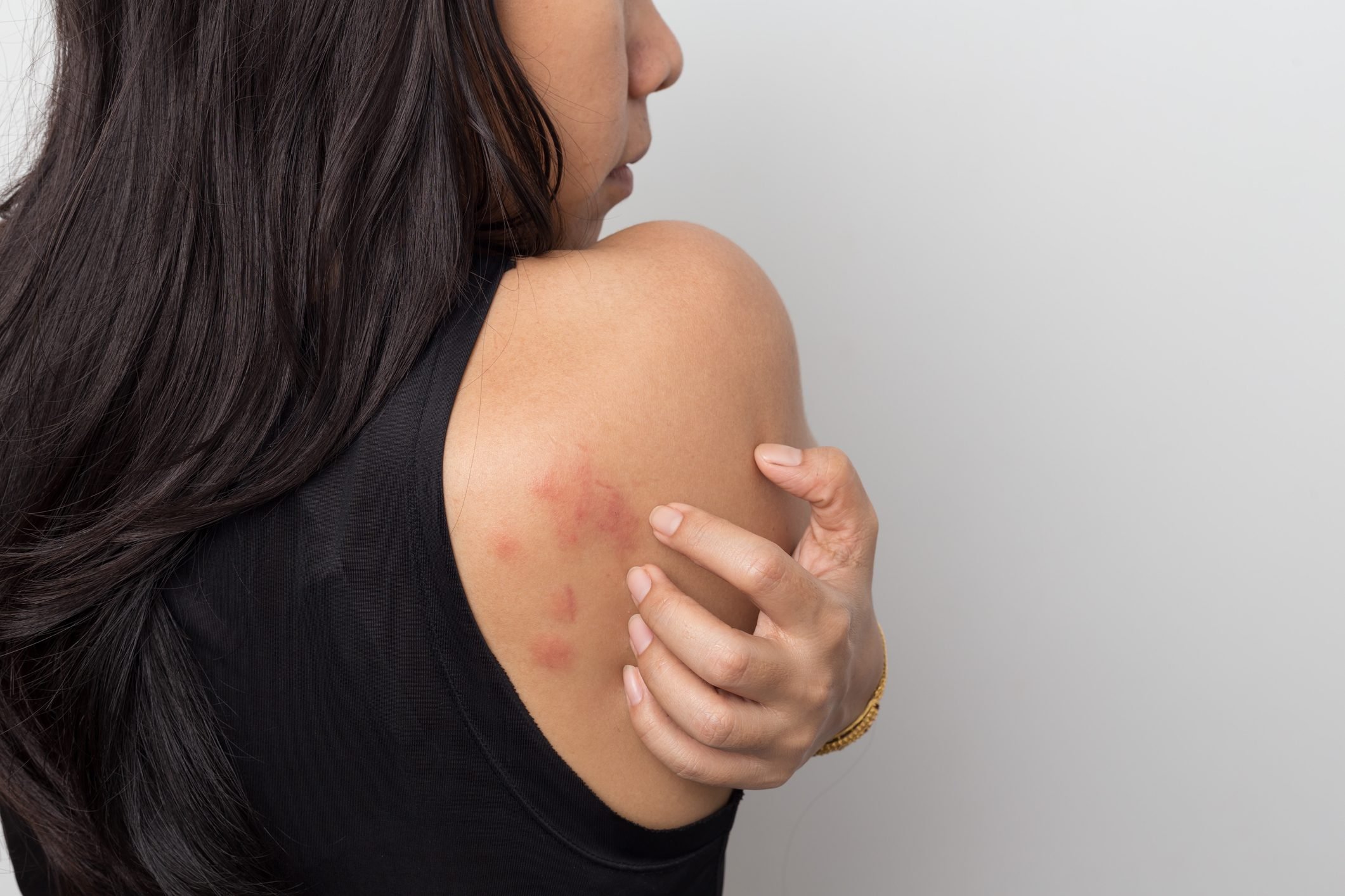 What Causes Hives? Everything You Need to Know About Urticaria