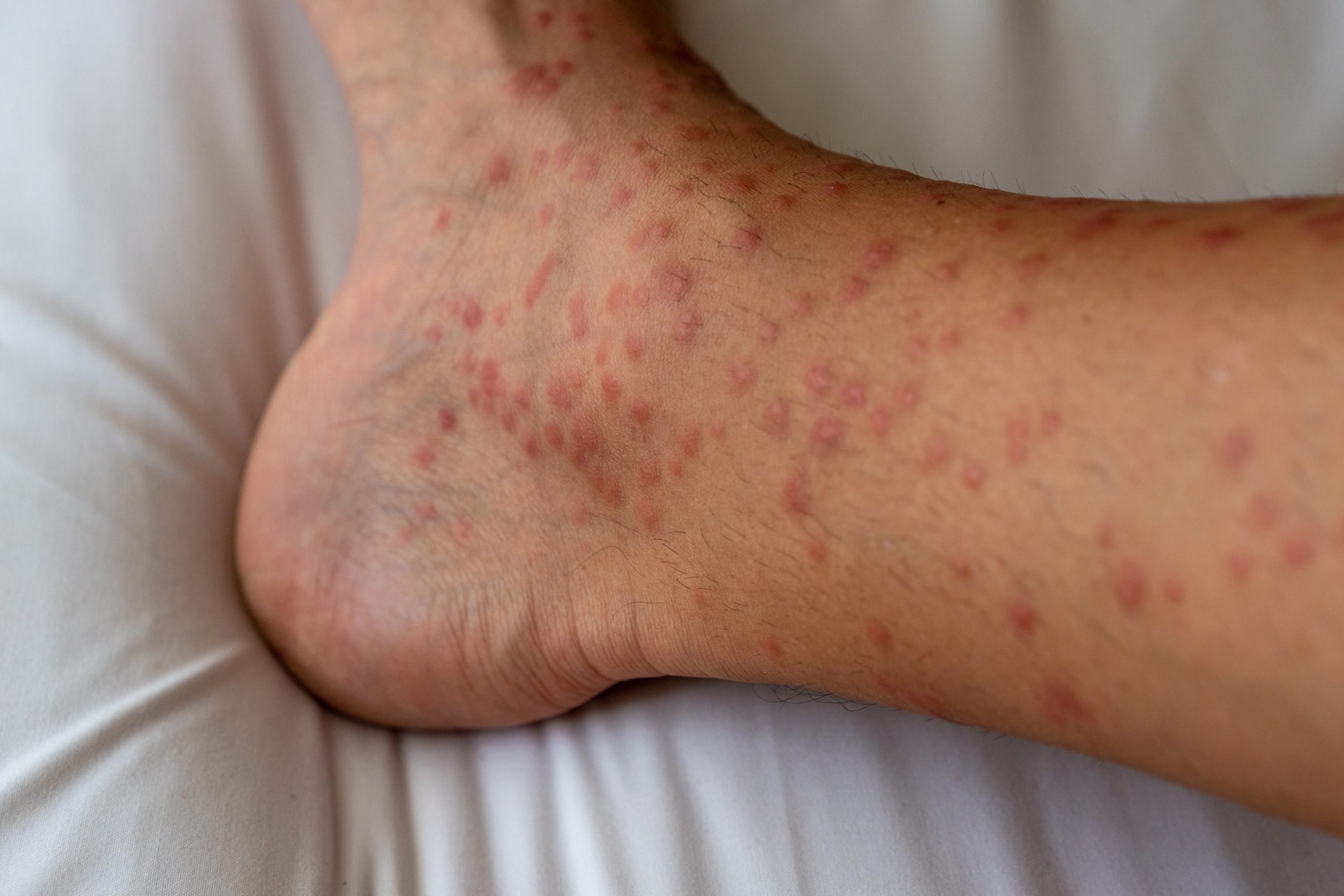 Have a Severe Reaction to a Bug Bite? It Could Be Papular Urticaria