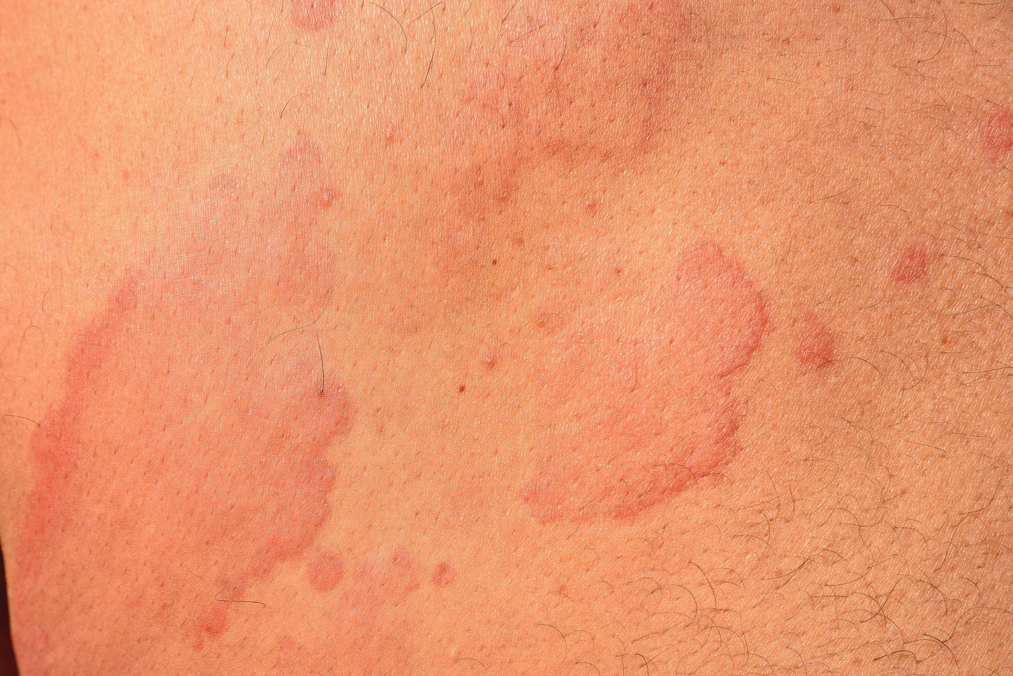 puede-el-estr-s-causar-urticaria-lo-que-debe-saber-sobre-la-urticaria