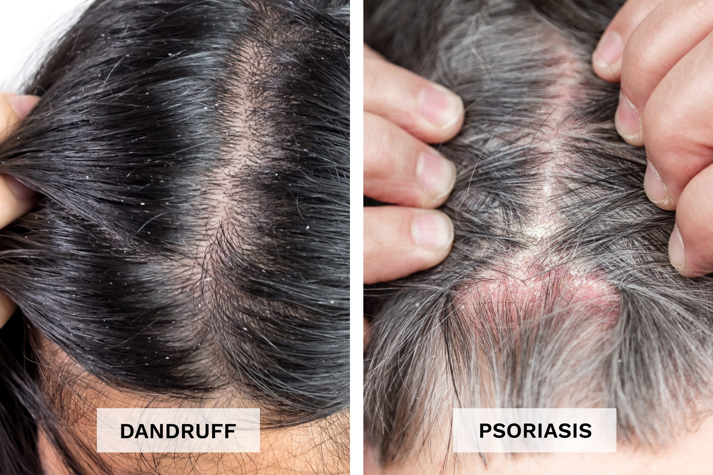 Scalp Psoriasis Vs Dandruff Whats Causing Your Flakes The Healthy