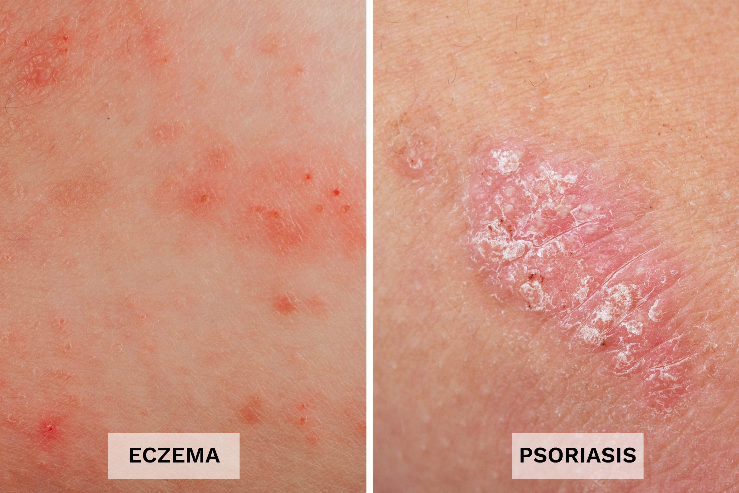 Eczema vs. Psoriasis 13 Differences You Should Know The Healthy