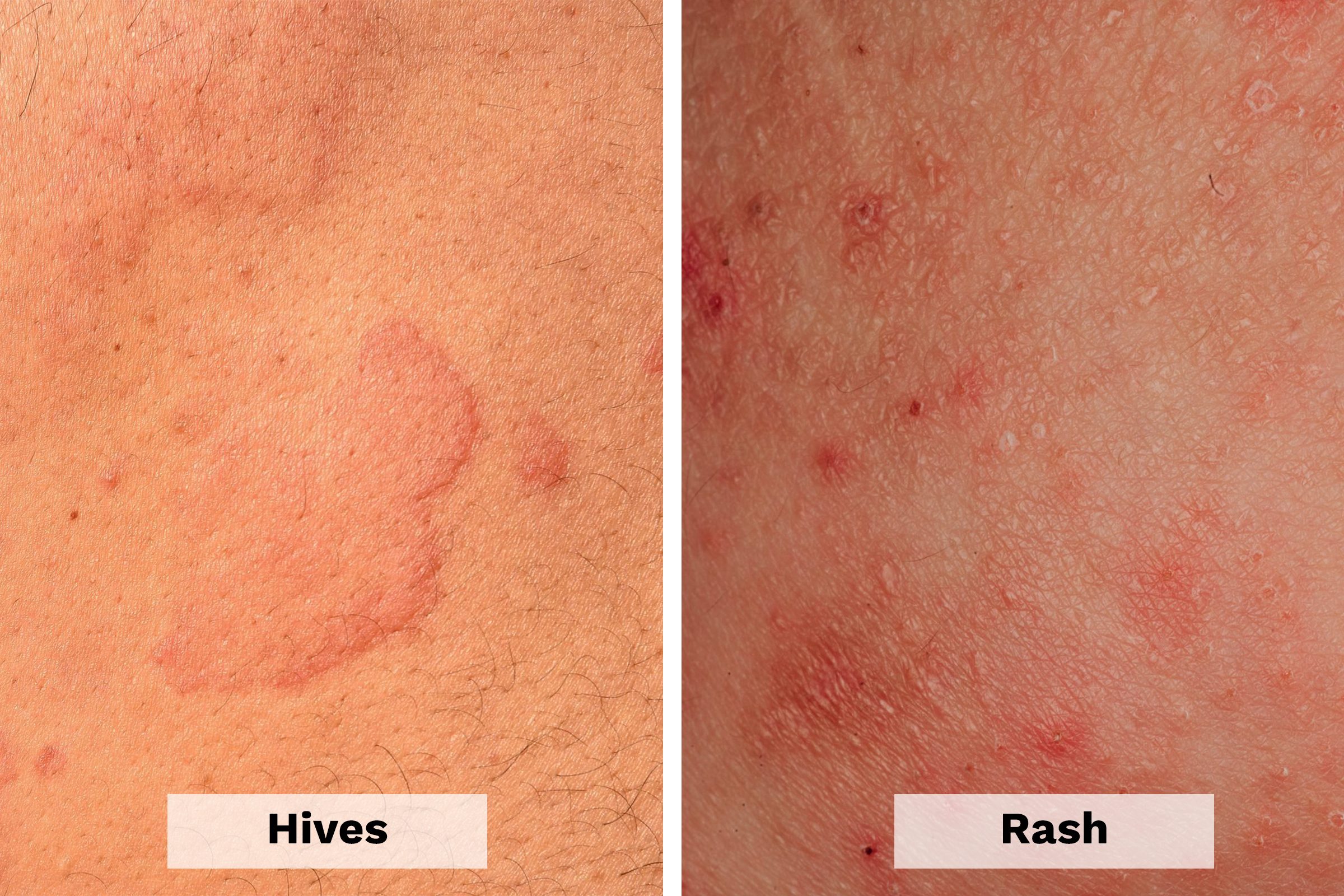 Hives Vs Rash Heres How To Tell The Difference The Healthy