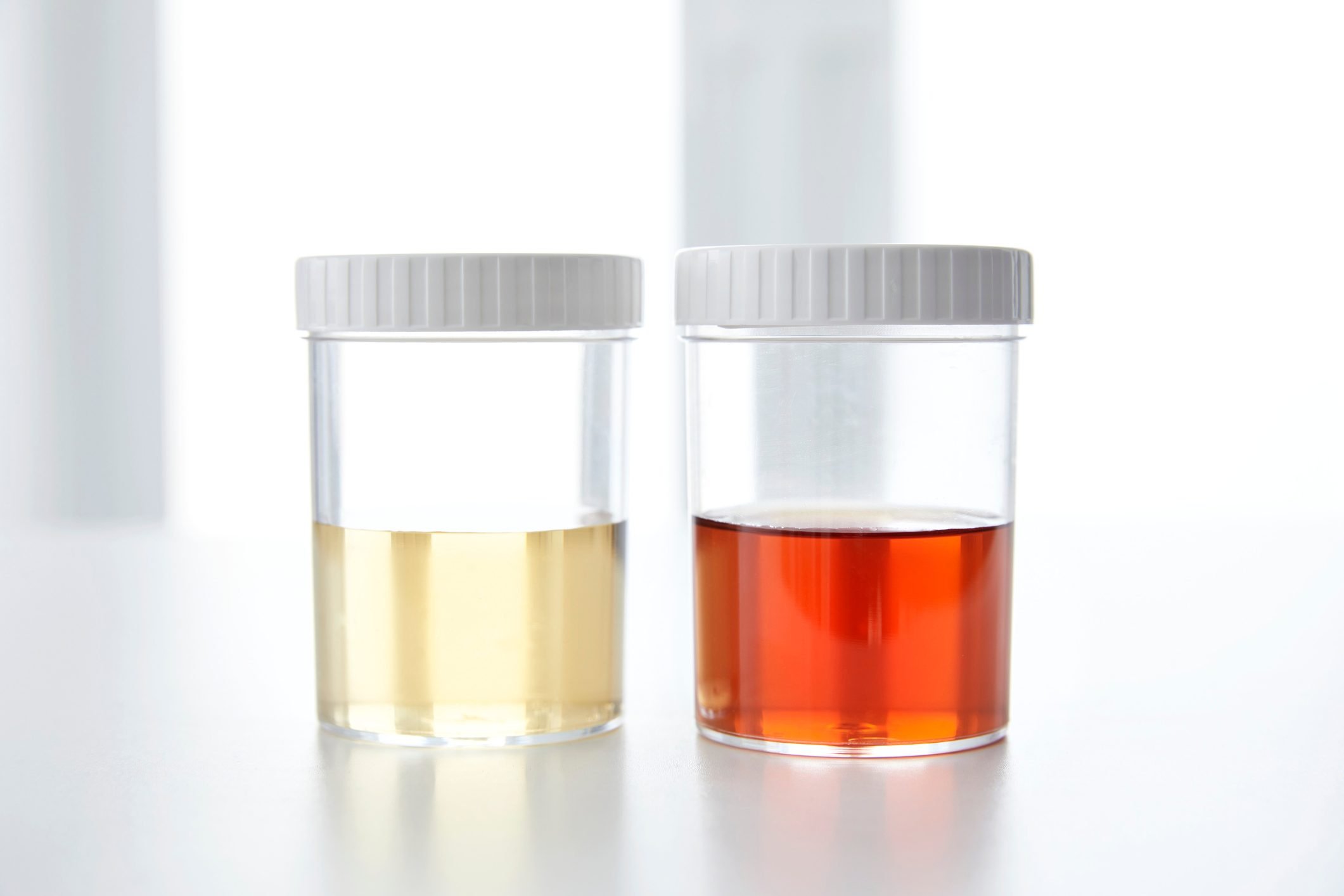 Urine Brown Discharge, Blood in the urine can look pink, red or cola-colored .