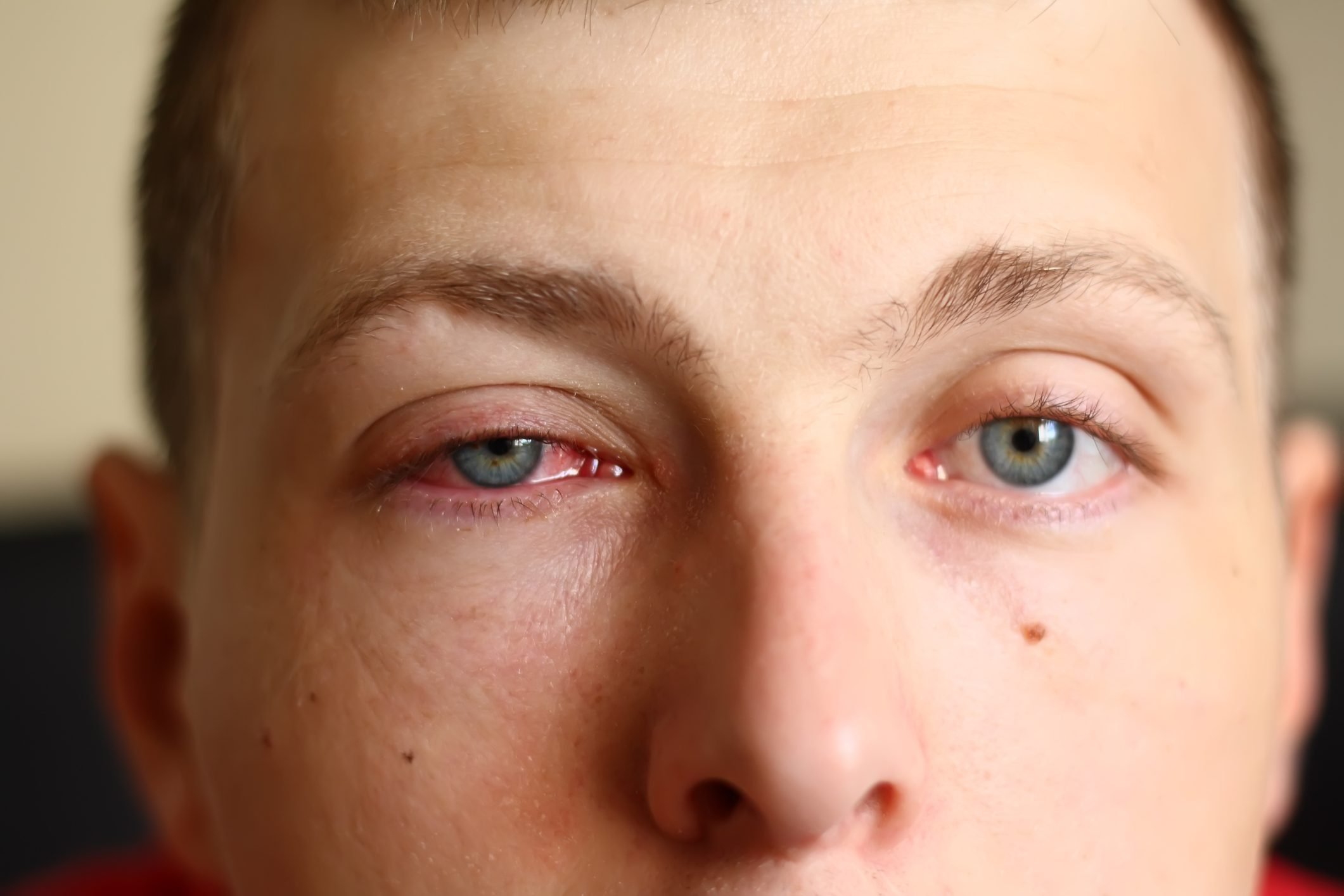 Pink Eye and Covid19 What You Need to Know The Healthy