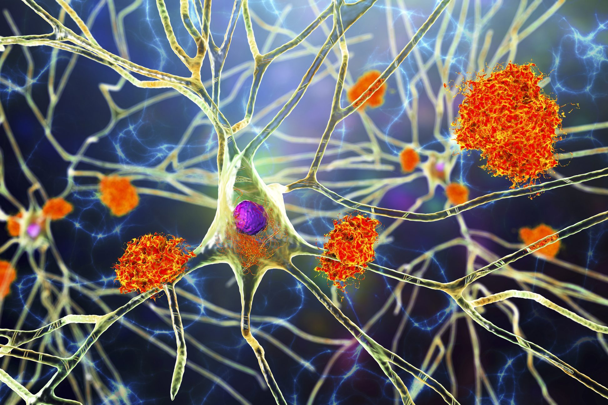 4 New Breakthroughs in Alzheimer's Research with Unprecedented Results, according to Doctors