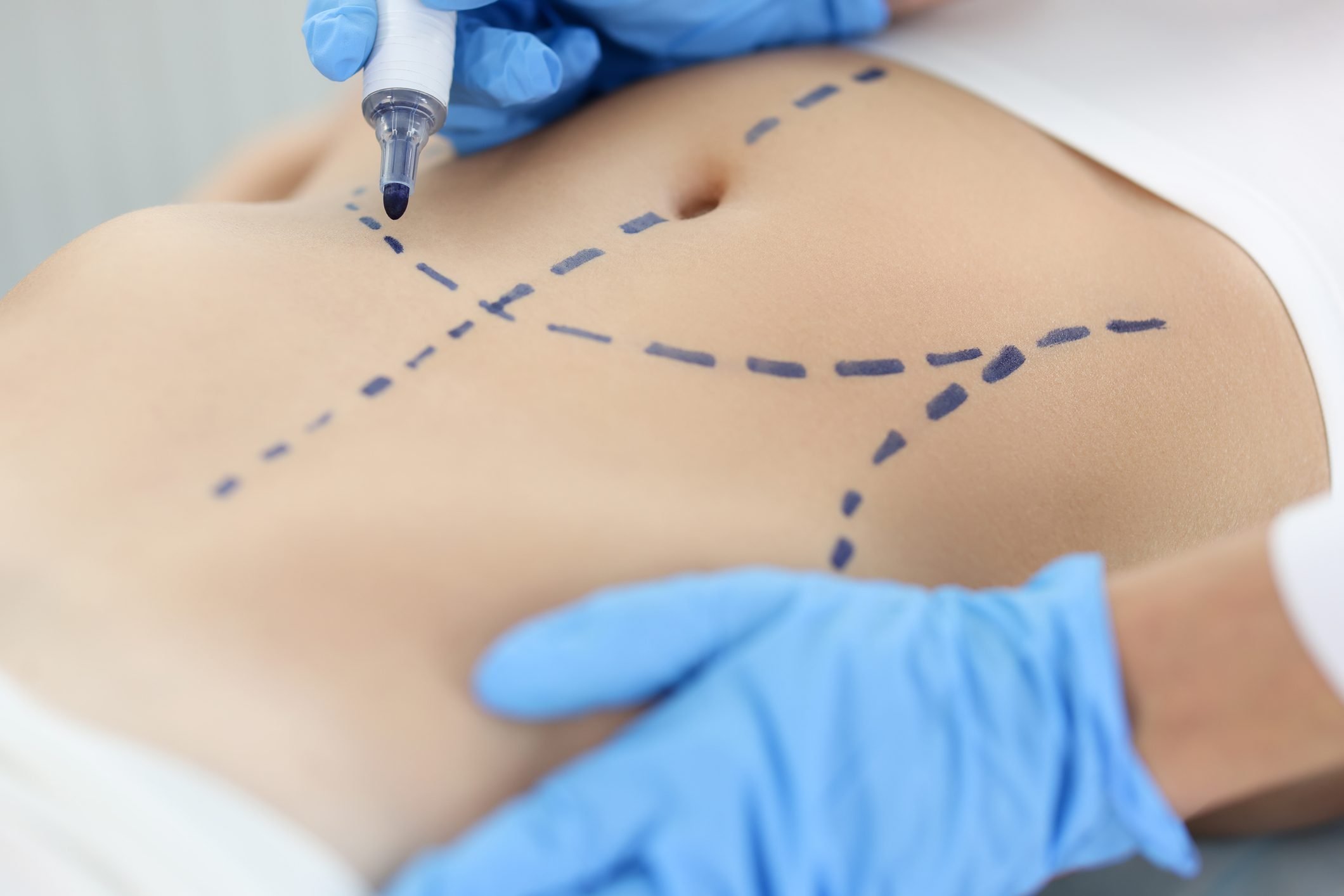 This Cosmetic Procedure Just Overtook Breast Augmentation As #1 in America