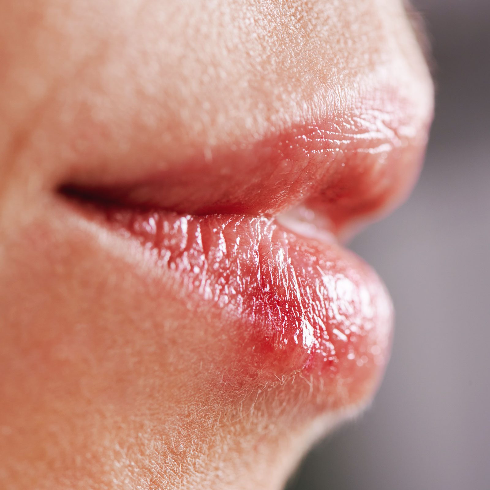 Sunburned Lips? Here's What Doctors Say You Should Do