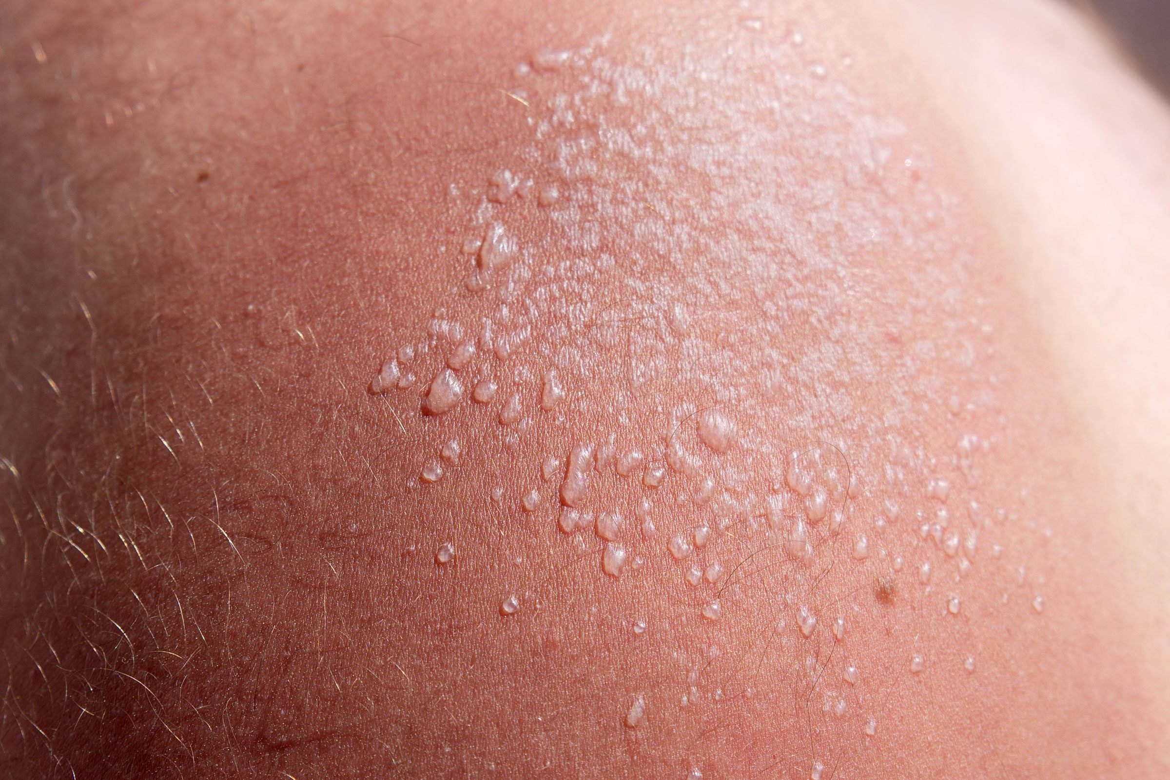 Sun Blister: Here's How to Tell If You Have One, and How to Treat It