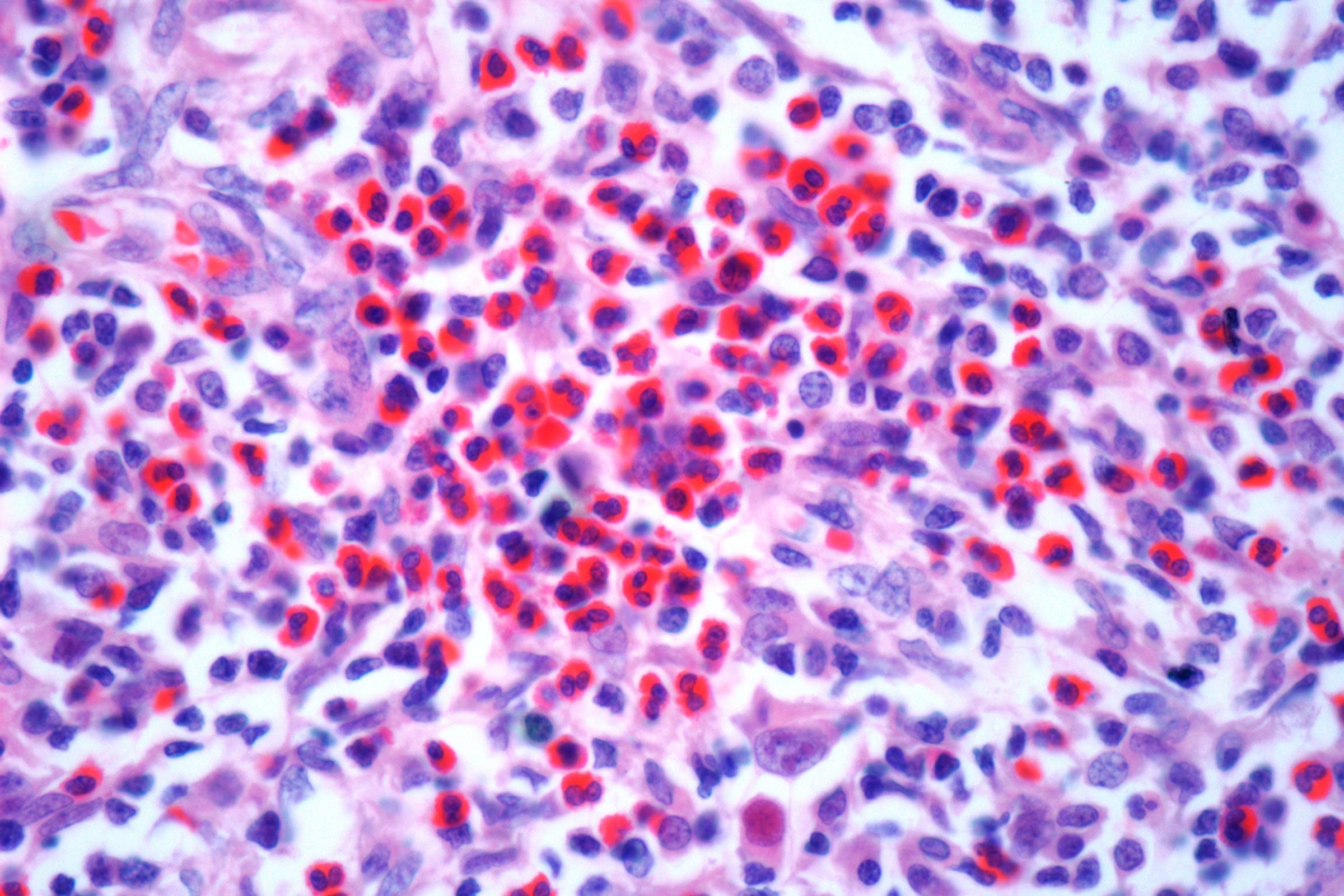 Hodgkin's lymphoma, light micrograph