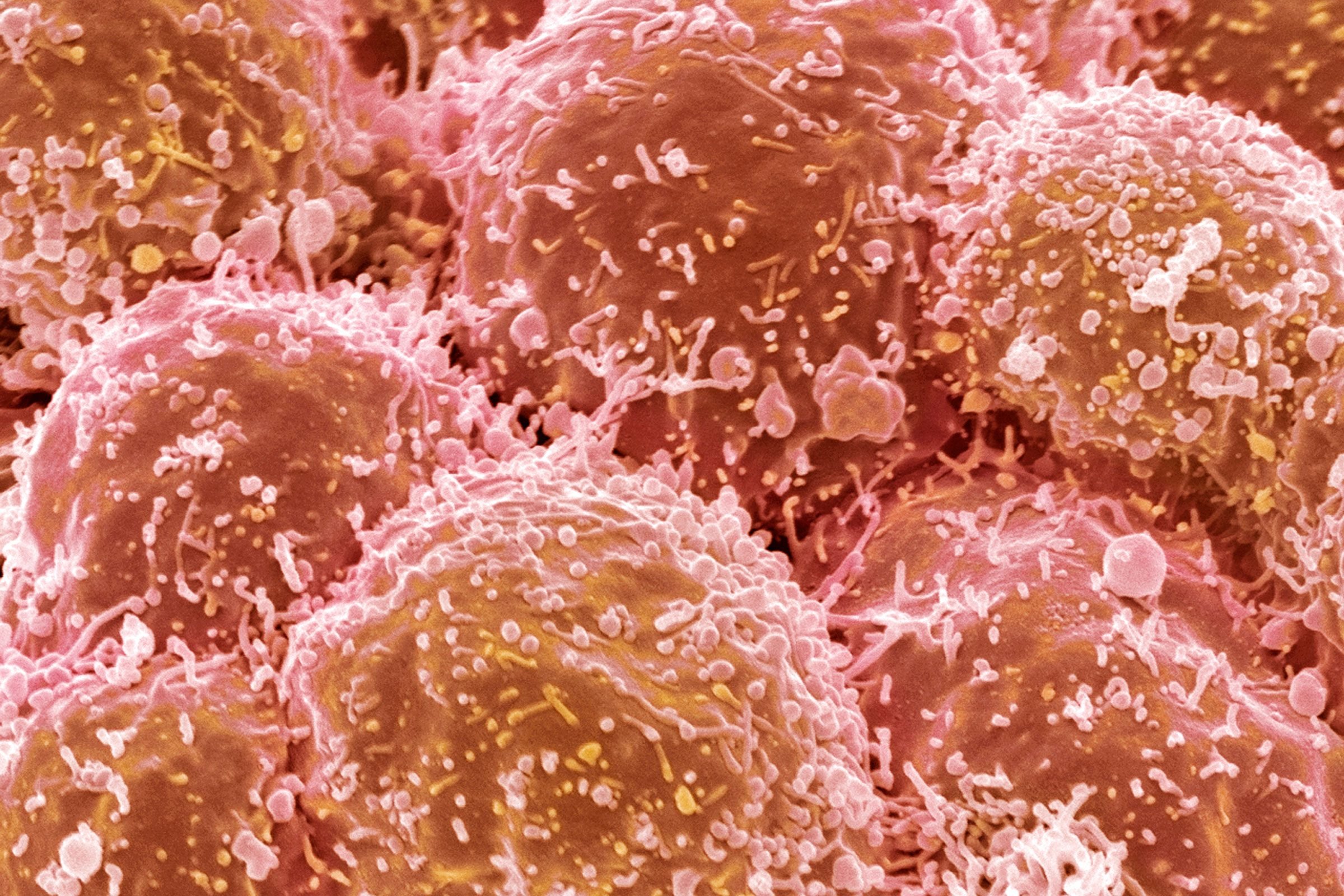 lung cancer cells