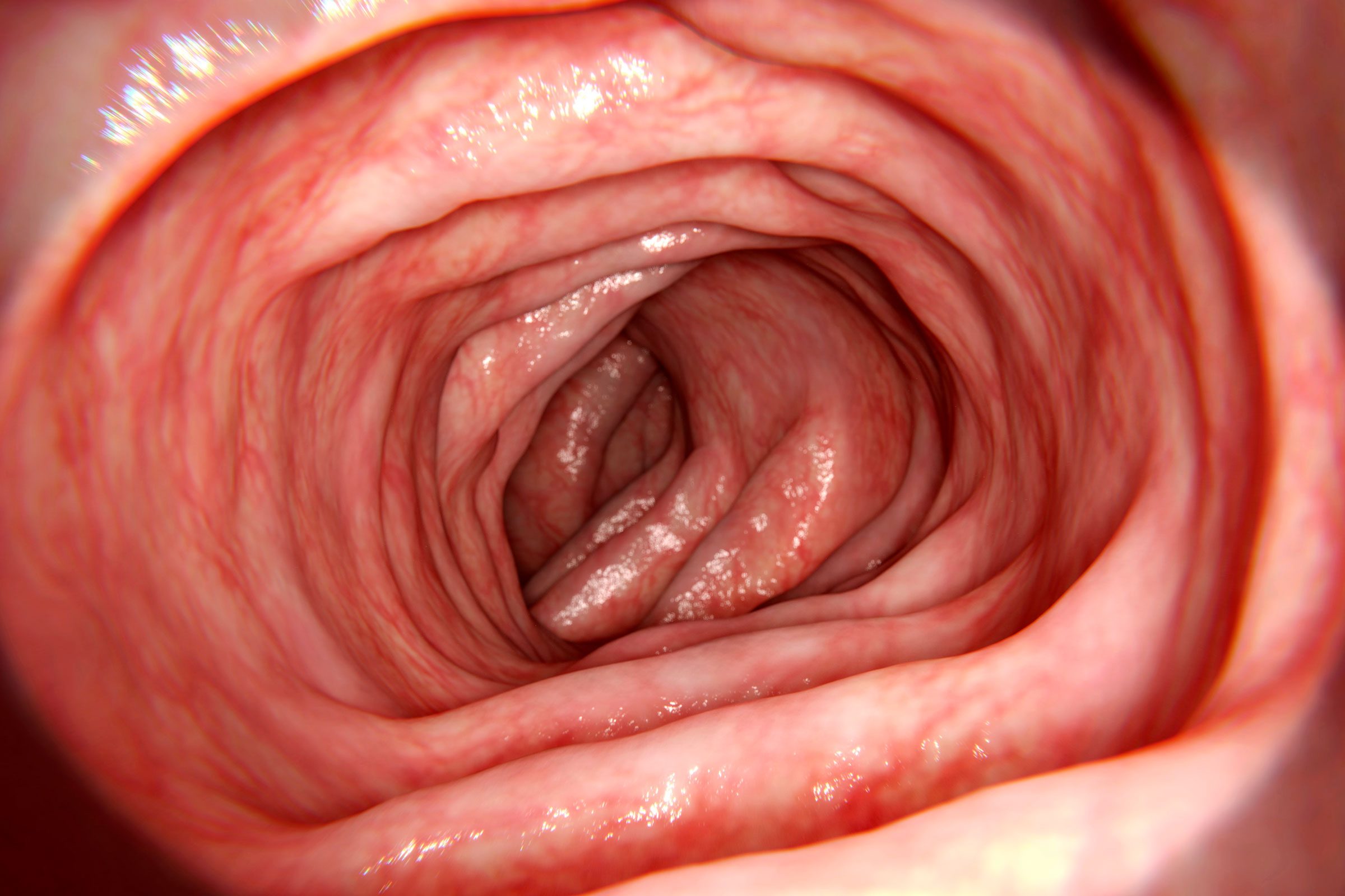 New Data: 80% of Americans Don't Know This Colon Cancer Risk