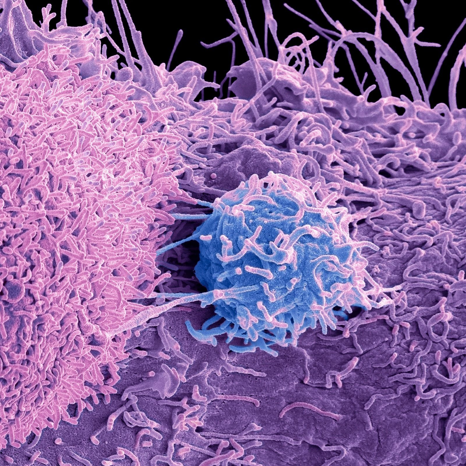 "Here's How I Knew I Had Prostate Cancer": One Patient's Story of Abruptly Elevated Markers