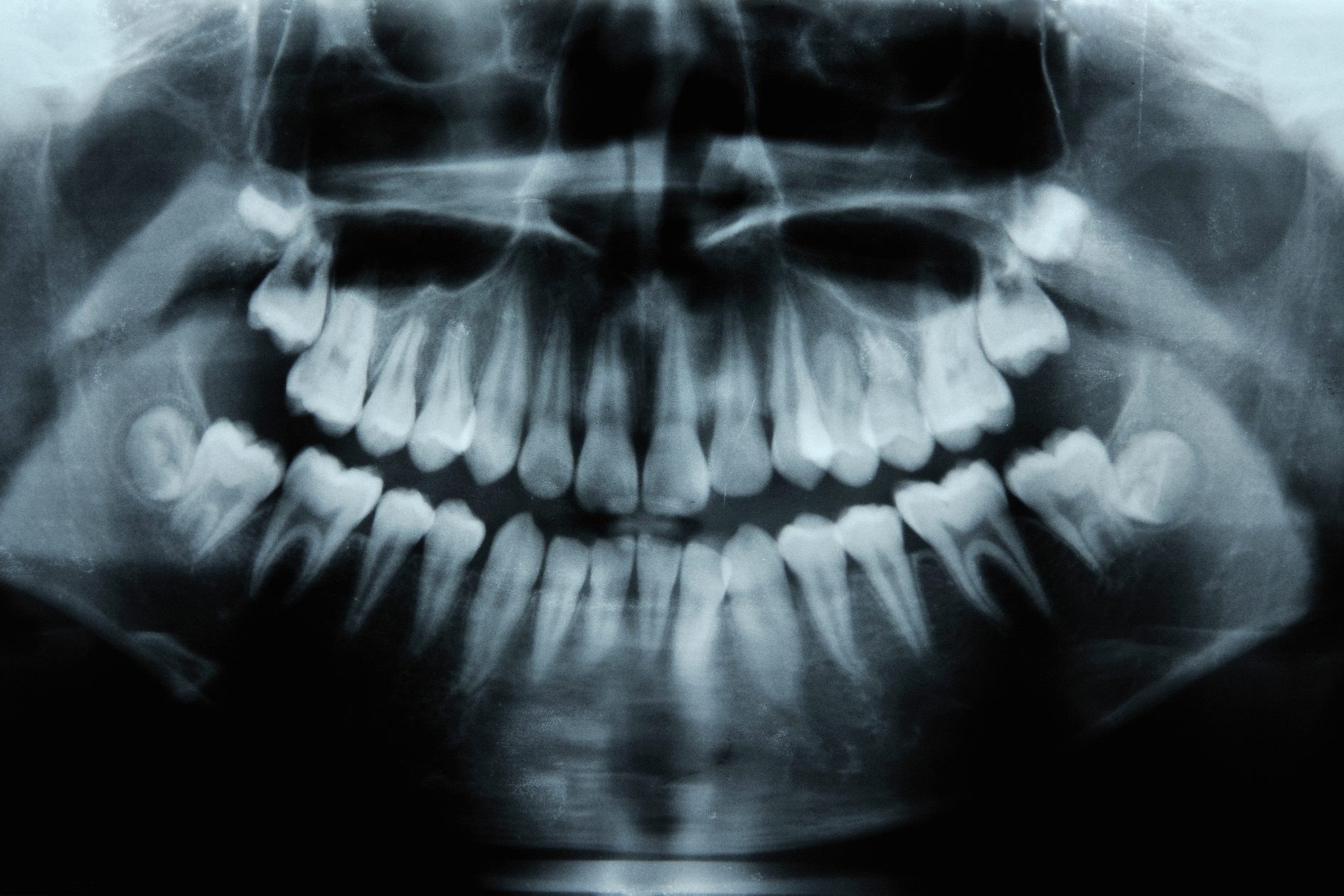 Child's dental X-rays