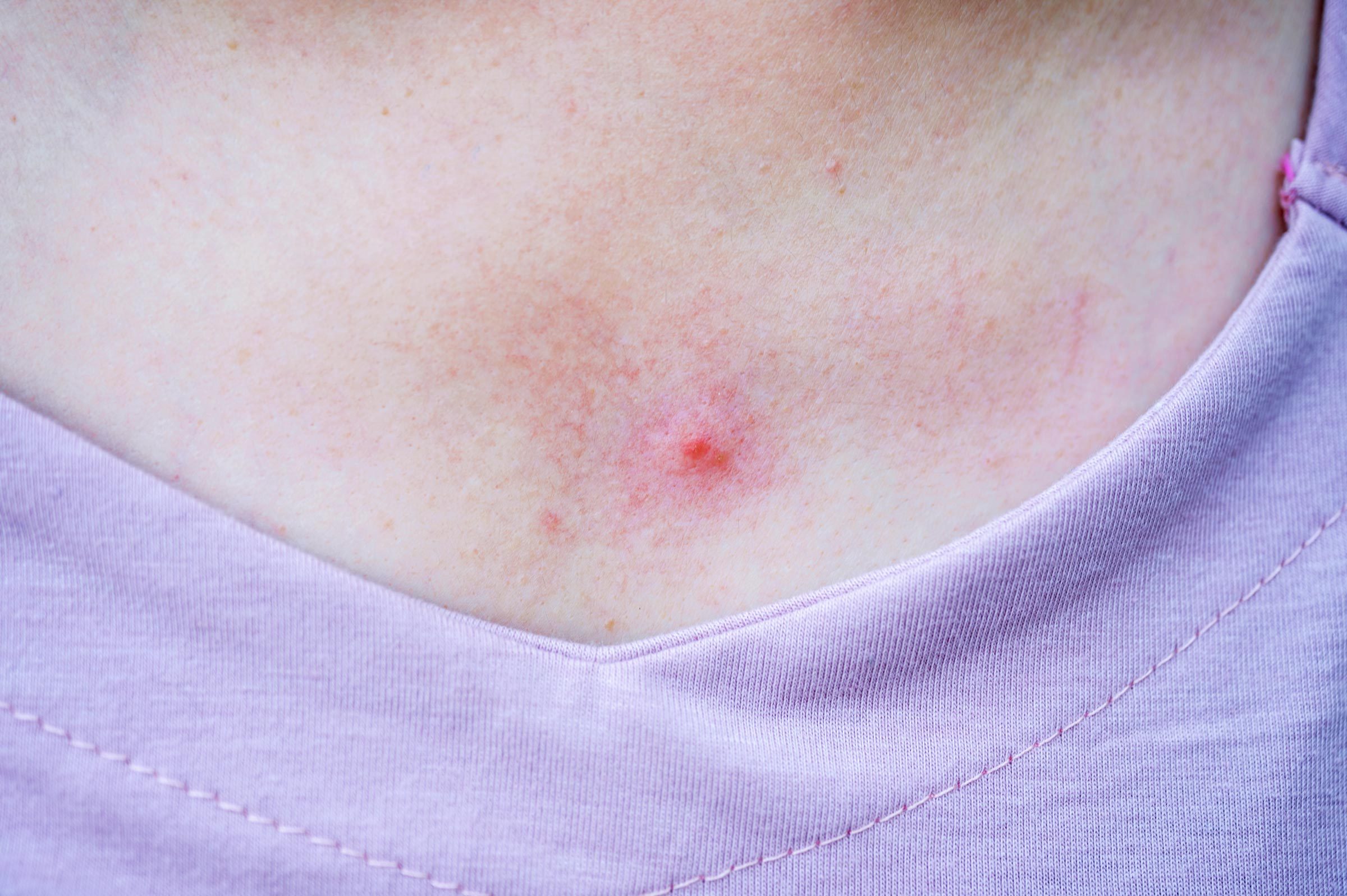 Sweat Pimples on chest close up