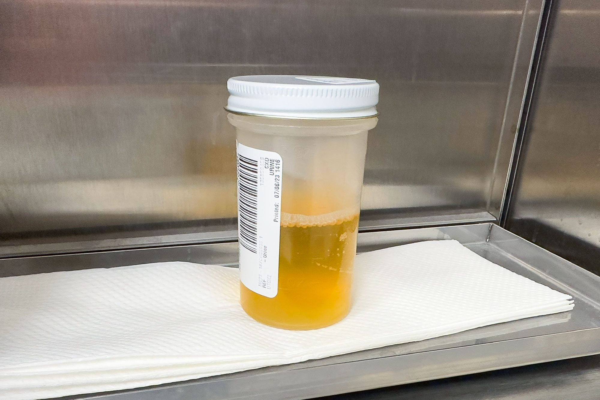 Urine Sample In A Clinical Specimen Container|